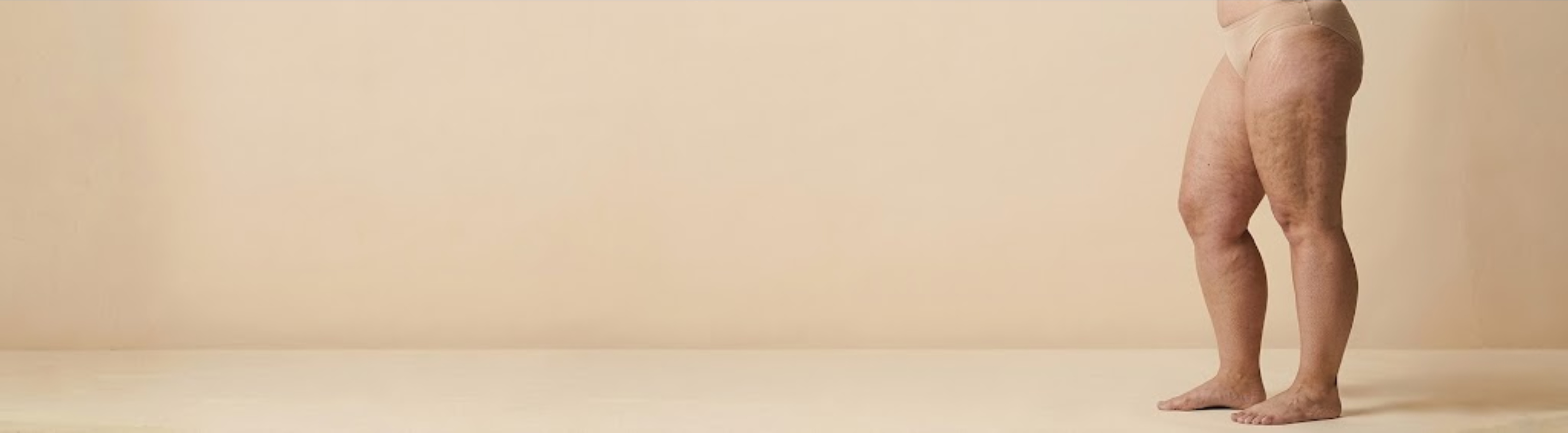 Lipedema